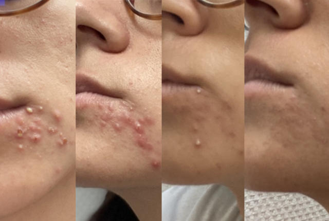 Roaccutane Pilules