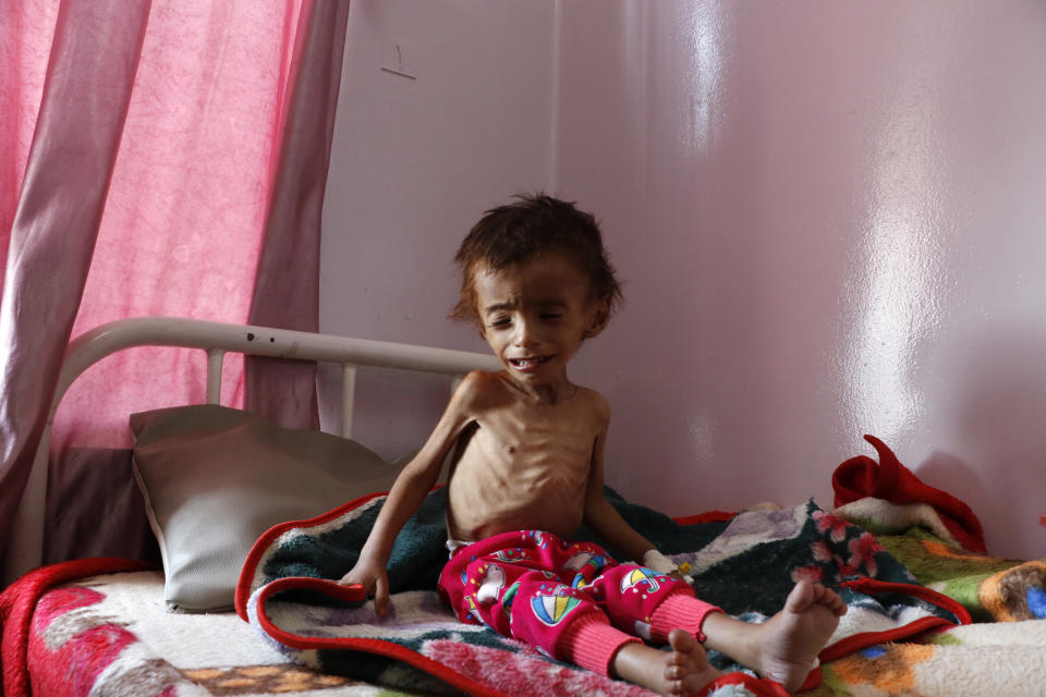 A malnourished child receives treatment at the Sabeen hospital in Sana'a, Yemen, on Oct. 6. Saudi Arabia's military campaign in Yemen has caused famine in the country. (Photo: Mohammed Hamoud via Getty Images)