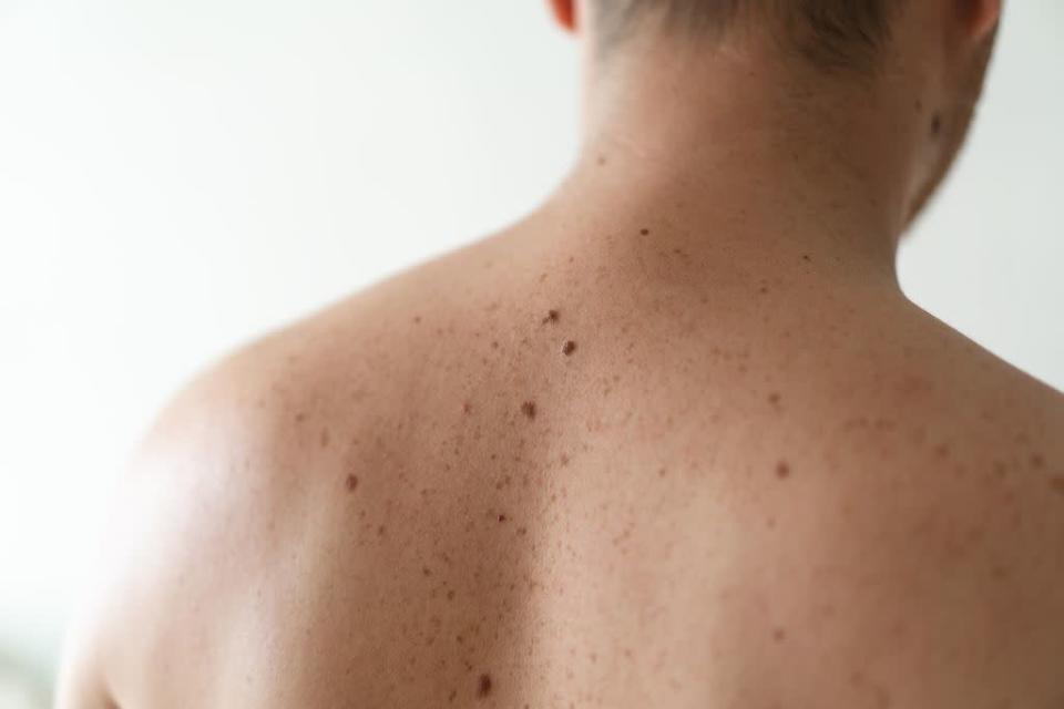 As pintas na pele são consideradas benignas pela medicina, mas é preciso ficar de olho para certificar-se de que não é uma doença (Imagem: StiahailoAnastasiia)