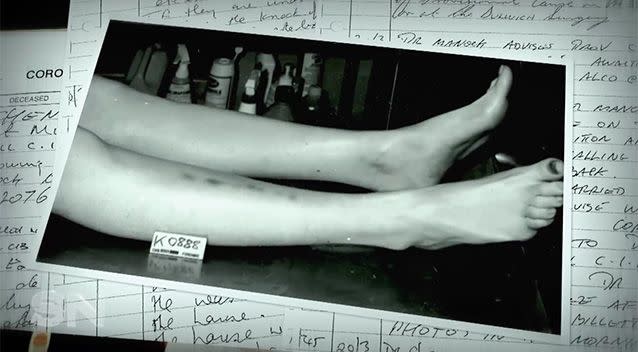 Dr Manock suggested the bruising on Anna-Jane's legs were a result of Henry lifting her legs over her head to drown her in the bathtub.