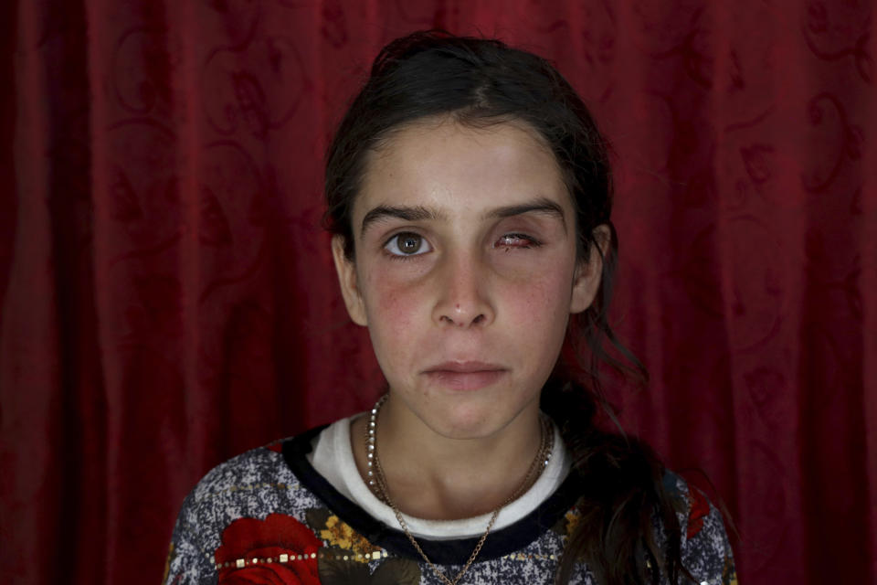 Rawaa al-Hassan, 12, who lost her eye to a cluster bomb in 2022, poses for a photograph at a camp near the town of Ain Sheeb, northern Idlib province, Syria, on July 18, 2023. More than 300 people were killed by cluster munitions in Ukraine in 2022, according to an international watchdog, displacing Syria as the country with the highest number of deaths from the controversial weapons for the first time in a decade. (AP Photo/Omar Albam)