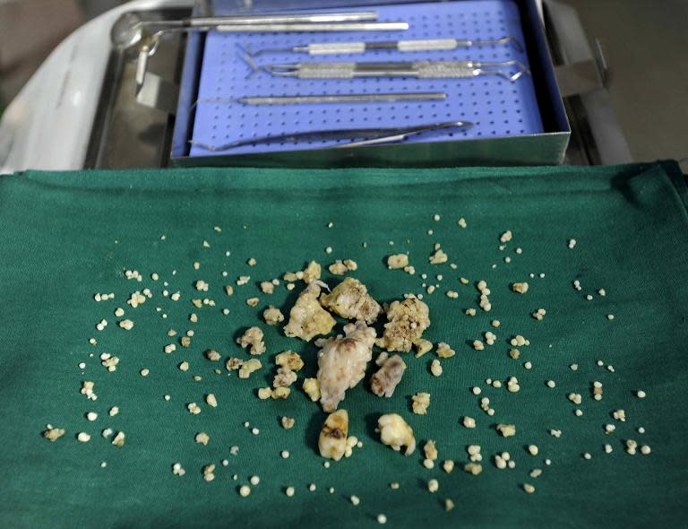 Dentists display teeth removed from 17-year-old Ashik Gavai at JJ Hospital in Mumbai on July 22, 2014