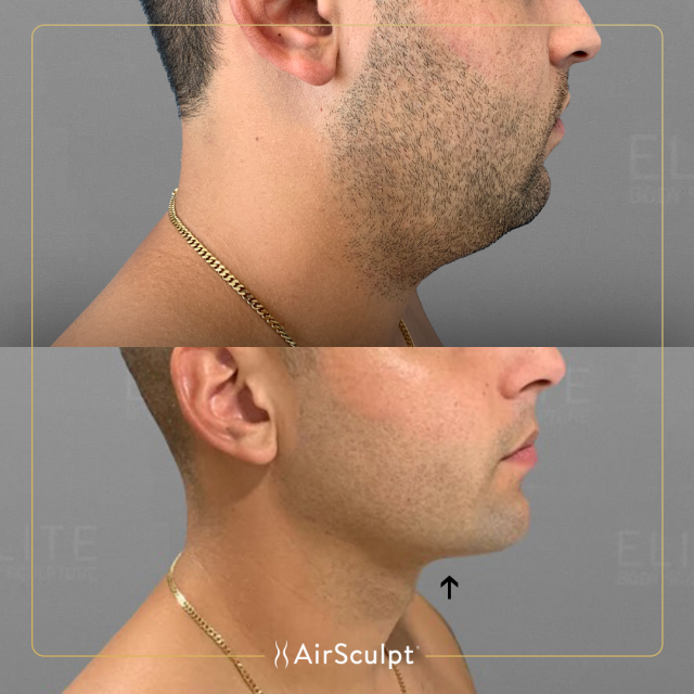 Elite Body Sculpture's Innovative Method, AirSculpt(R), is