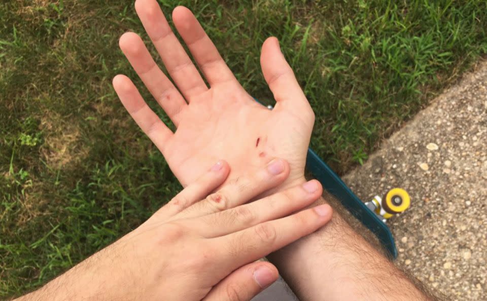 Mike Schultz shows injuries he received when he crashed his skateboard while playing Pokemon Go. Photo: AP