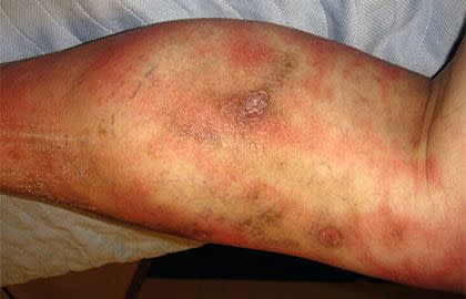 Exemple de cellulite sur la jambe. Image via the American Academy of Dermatology.