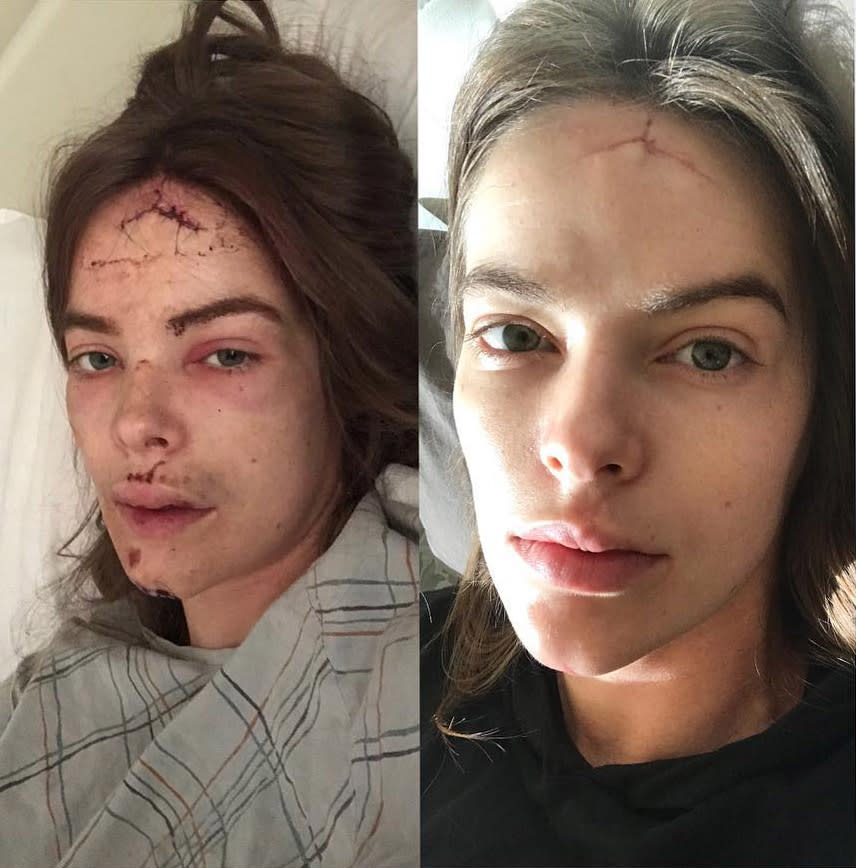 Robyn in hospital (left) after a seizure-induced fall down the stairs in 2018 and (right) showing off her 'lighting bolt' forehead scar two months later. Photo: Instagram/robynlawley.