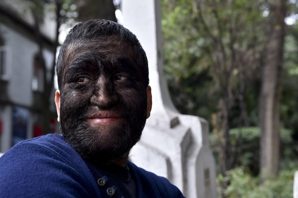 closeup of a person with a hairy face