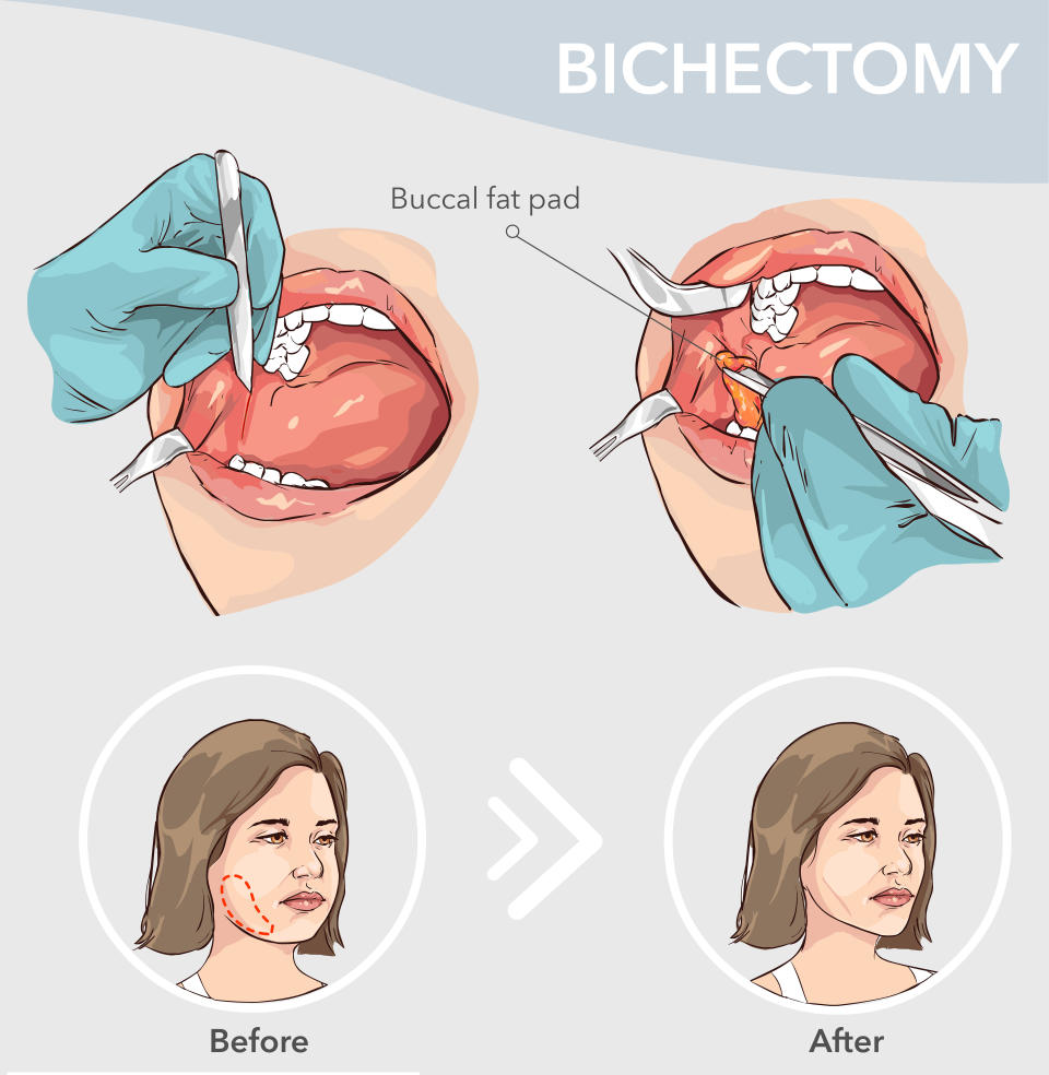 Buccal fat removal before and after. / Credit: Getty Images/iStockphoto