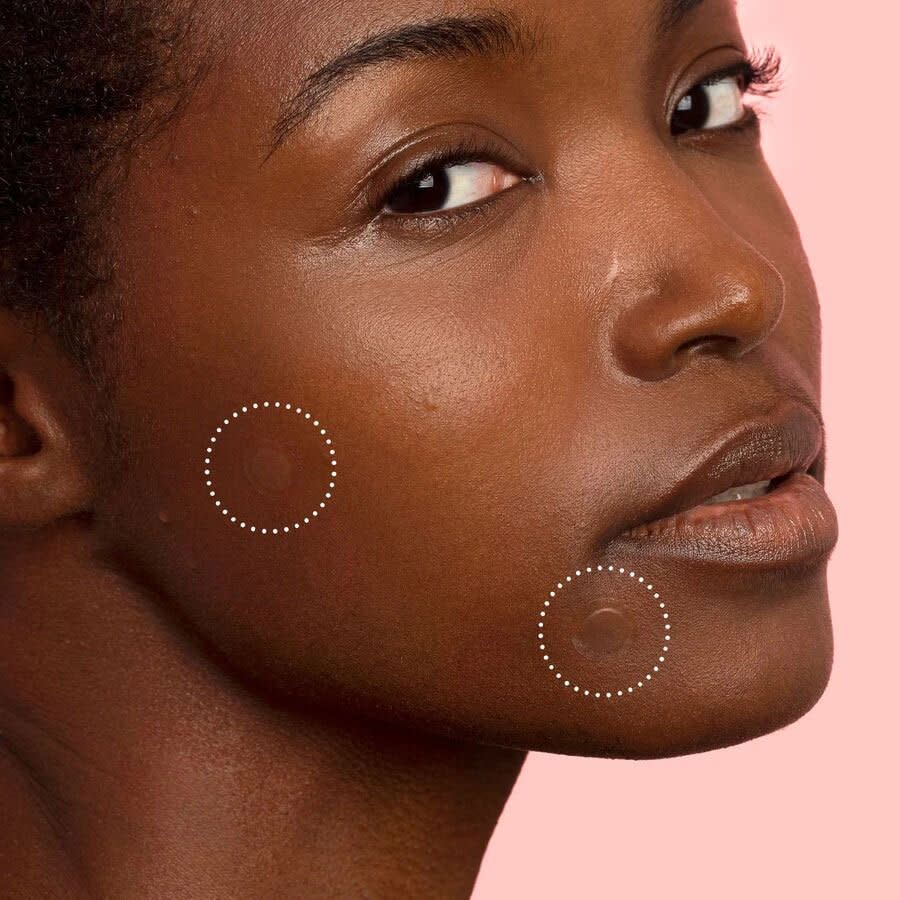 Amazon Shoppers Say These ‘Miracle Patches’ Get Rid of Stubborn Cystic Acne — and They’re Almost 40% Off