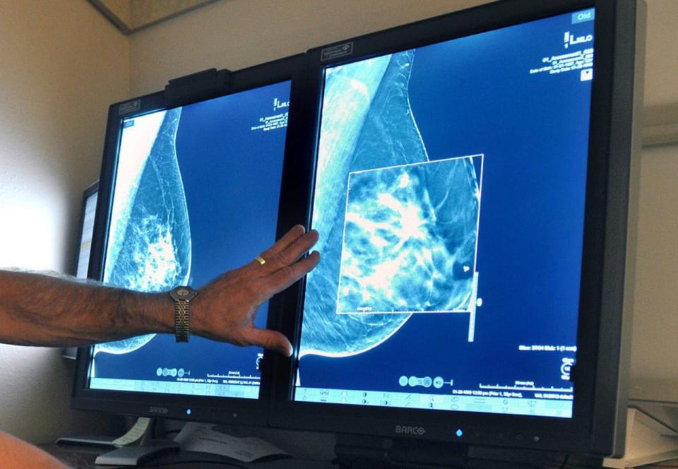 In this Tuesday, July 31, 2012, file photo, a radiologist compares an image from earlier, 2-D technology mammogram to the new 3-D Digital Breast Tomosynthesis mammography in Wichita Falls, Texas. The technology can detect much smaller cancers earlier. Chances of dying from DCIS (ductal carcinoma in situ), a very early form of breast cancer are small but the disease is riskier for young women and blacks - disparities seen previously in more advanced cancer, according to a large study published Thursday, Aug. 20, 2015 in JAMA Oncology.