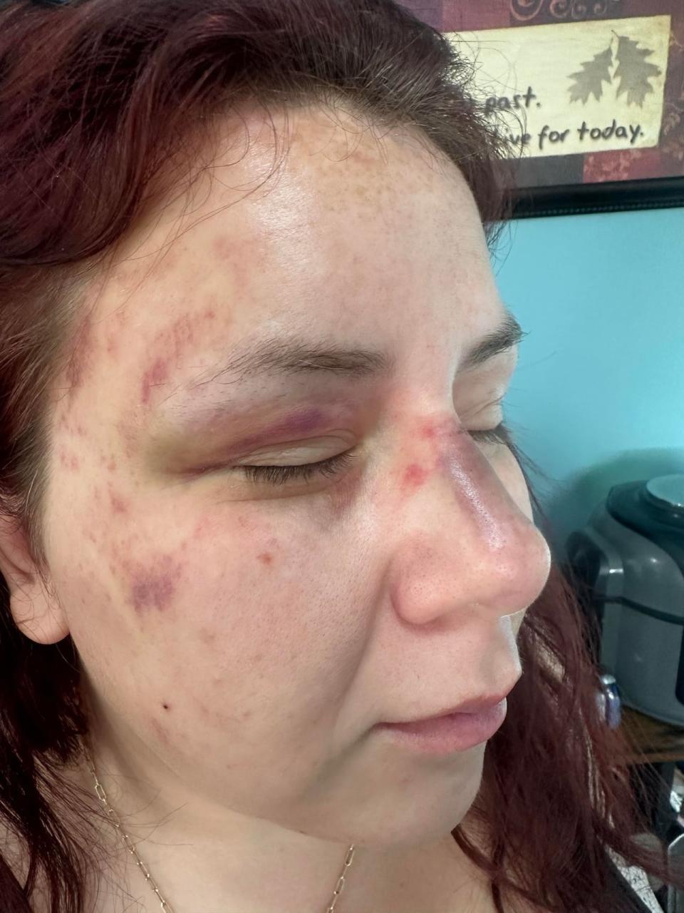 Rebecca Larkham said her had bruises and a broken nose, but her daughter only had a small cut and mother and sister had bruises. Larkham said the crash could have been worse. 