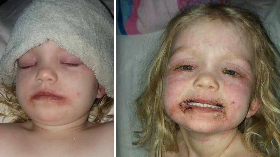 The three-year-old suffered a severe allergic reaction to some cheap make-up. Source: Facebook/Tony Kylie Cravens