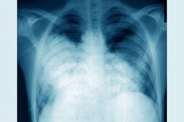 PHOTO: Acute bilateral pneumonia (legionnaires disease caused by Legionella pneumophila), seen on a frontal chest x-ray. (BSIP/Universal Images Group via Getty Images, FILE)