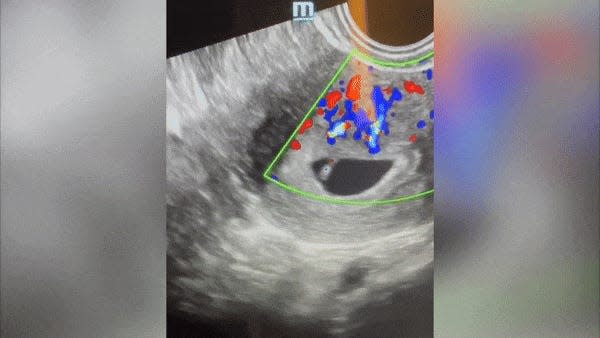 An ultrasound of the embryo created by Conceivable's first remote ICSI.