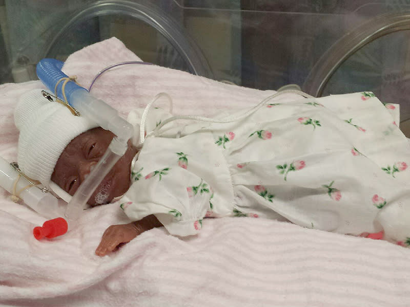 One of the Smallest Babies Ever Born (at Just 10 Ounces) Beats the Odds and Goes Home From Hospital| Babies, Real People Stories