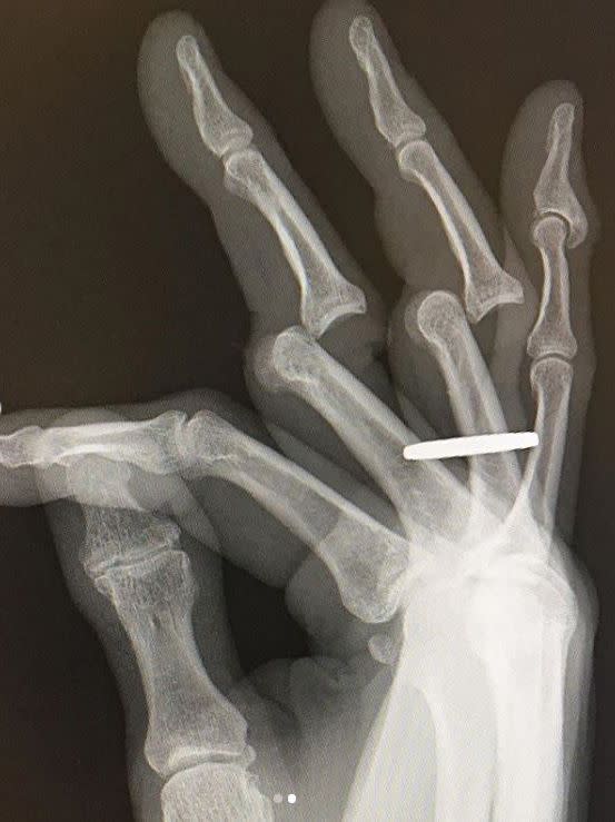 Tony Hawk showed fans the X-ray of a recent injury he sustained to his hand on June 10, 2020. “Just received my x-rays from Saturday’s debacle,” he wrote alongside the X-ray. “They had to cut my ring off before returning my bones to their full upright and locked position. My fingers are still sore / stiff / swollen but mostly functional. And I still love my job. #duskydigits #bruisedbonesbrigade”.