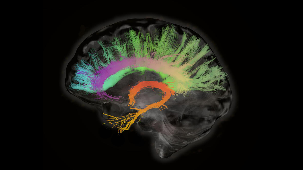  Colorful x-ray photograph of a human brain. The fiber tracts involved in aging. The splenium and genu of the corpus callosum, the fornix and the cingulum bundle. 