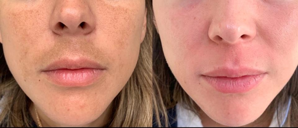 A Skin Medicinals patient before and after using a compounded topical for melasma.