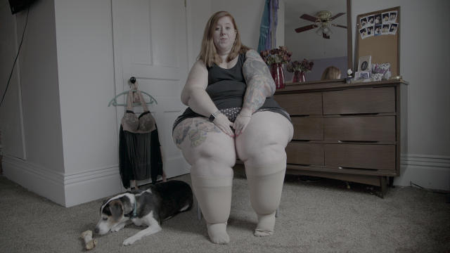 Lymphedema Warrior Embraces Her Pear Shape