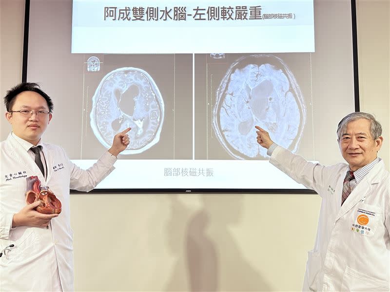 中國醫藥大學兒童醫院「結構與先天性心臟病及超音波中心」副院長謝凱生教授（右）、戴以信醫師（左）指出，國內腦膿瘍好發年齡多為六十歲以上的男性。（圖／翻攝自中國附醫網站）