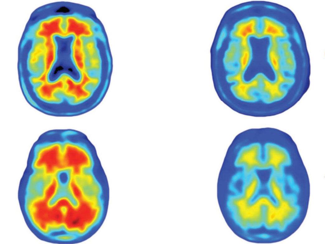 Brain scans highlighting the deposits of amyloid plaques in Alzheimer’s patients: Sevigny et al