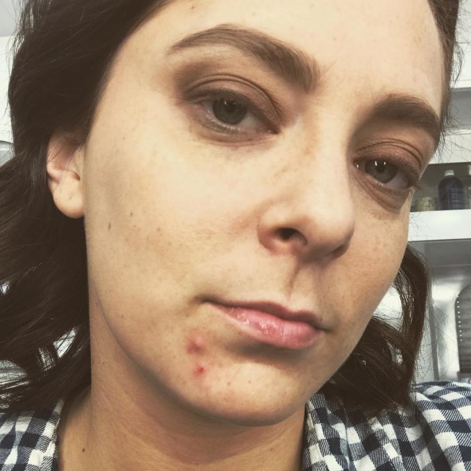 <p>Vu l’ampleur que ce mouvement a pris, il n’est donc plus rare de voir des clichés de jeunes femmes avec des boutons, des points noirs ou toute autre imperfection de la peau. Crédit photo : Instagram racheldoesstuff </p>