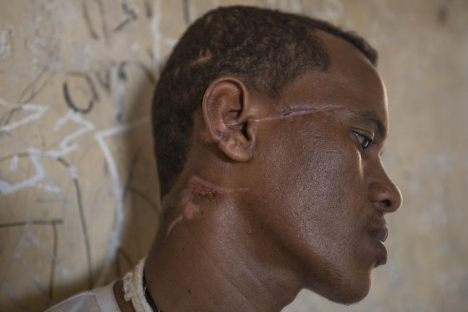 Abrahaley Minasbo a 22-year-old trained dancer and Tigrayan survivor from Mai-Kadra, Ethiopia, shows wounds on his face inside a shelter, in the Hamdeyat Transition Center near the Sudan-Ethiopia border, eastern Sudan, Tuesday, Dec. 15, 2020. Minasbo said Amhara militia members dragged him from his home in Mai-Kadra on Nov. 9 and beat him in the street with a hammer, an axe, sticks and a machete, then left him for dead. Scars now slope across the right side of his face and neck. (AP Photo/Nariman El-Mofty)