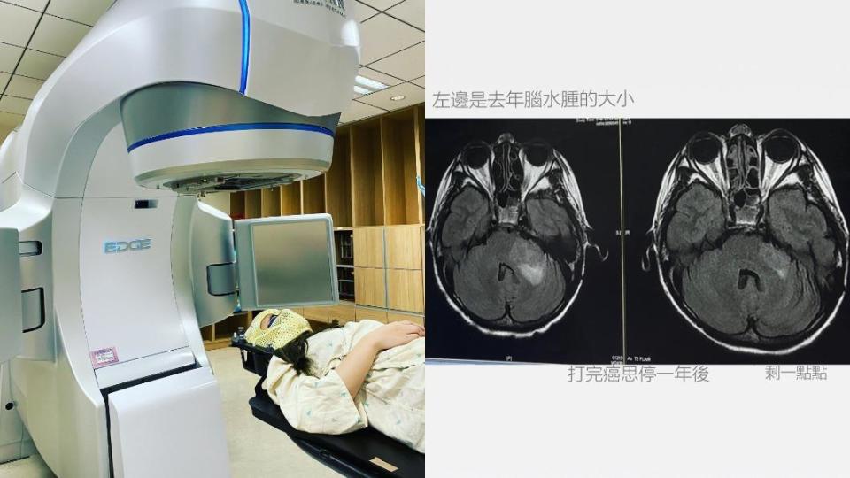 陳筱蕾曬X光照透露腦瘤從去年的3.3cm變成2.6cm。（圖／翻攝自陳筱蕾臉書）