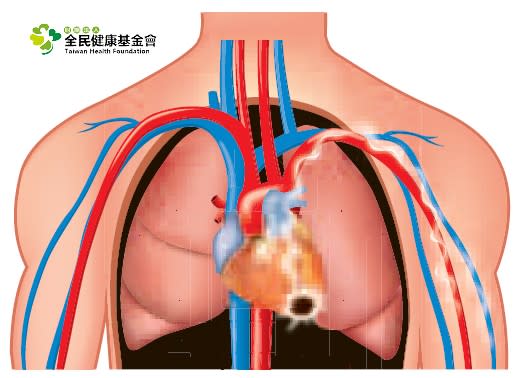 Angina, the feeling of pain sometimes radiate to the inside of the left arm.