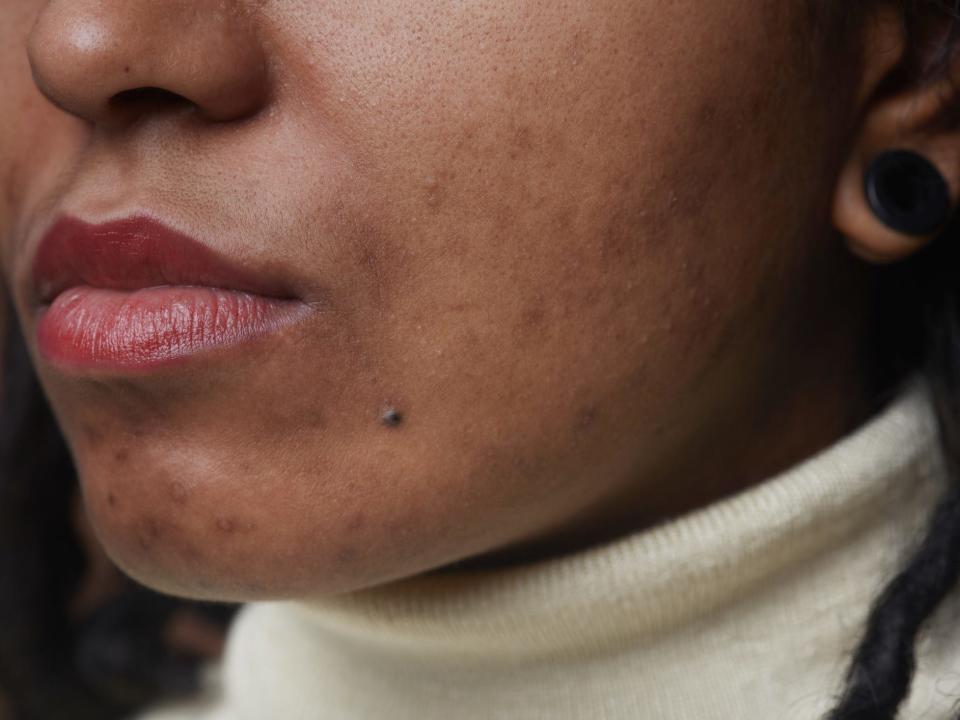 A Black woman with acne on her chin.