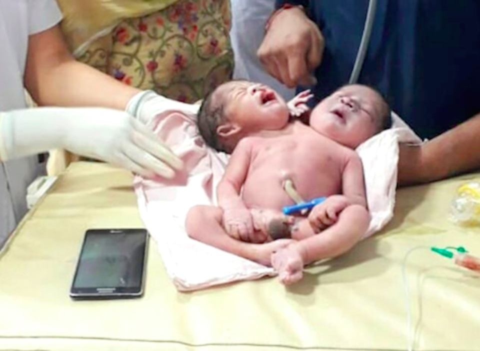 The twins were born by caesarean section (Picture: Caters)