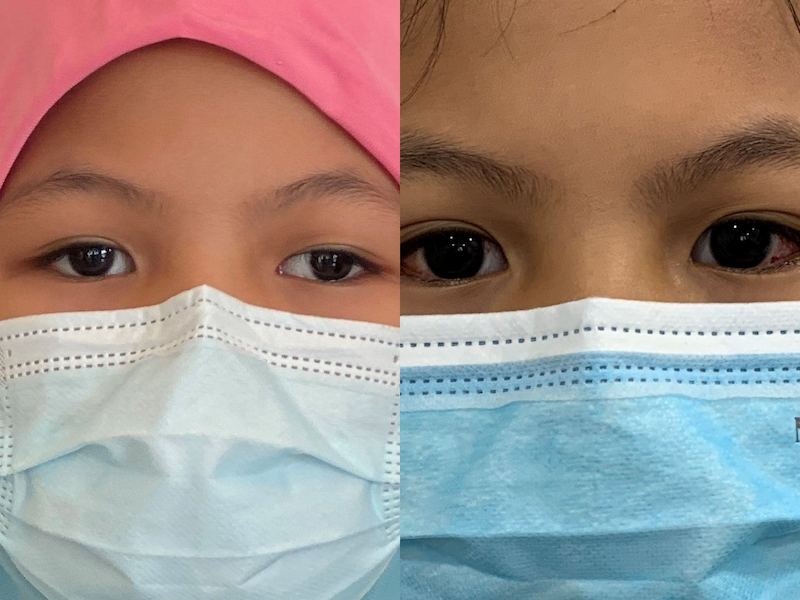 Mia’s eyes before (left) and after (right) the squint surgery. — Photo by Jasmin Zainal