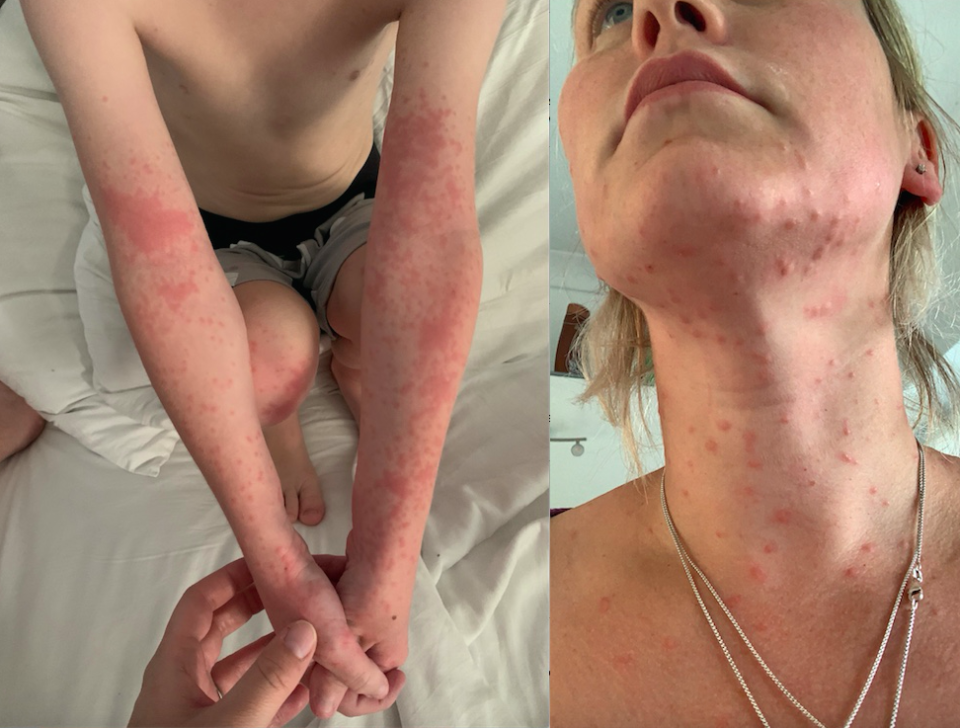 A mum and her children have experienced a reaction after coming into contact with toxic caterpillars. (SWNS)