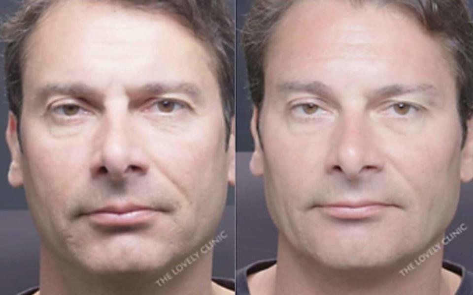 Stephen Taylor-Brown before (left) and after (right) he had treatment at The Lovely Clinic 