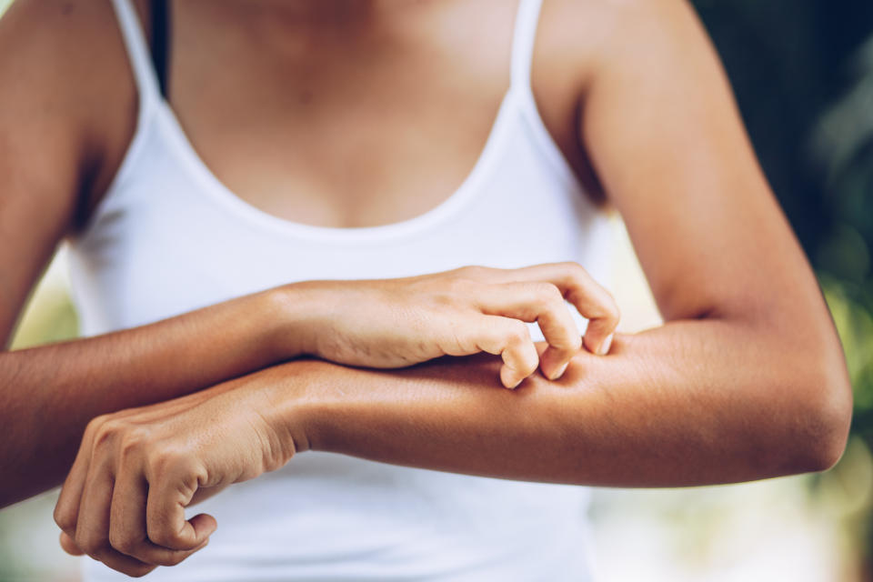 Bloß nicht kratzen! Gegen den Juckreiz gibt es eine Vielzahl an Hausmitteln, die jeder schnell zur Hand hat. (Bild: Getty Images)