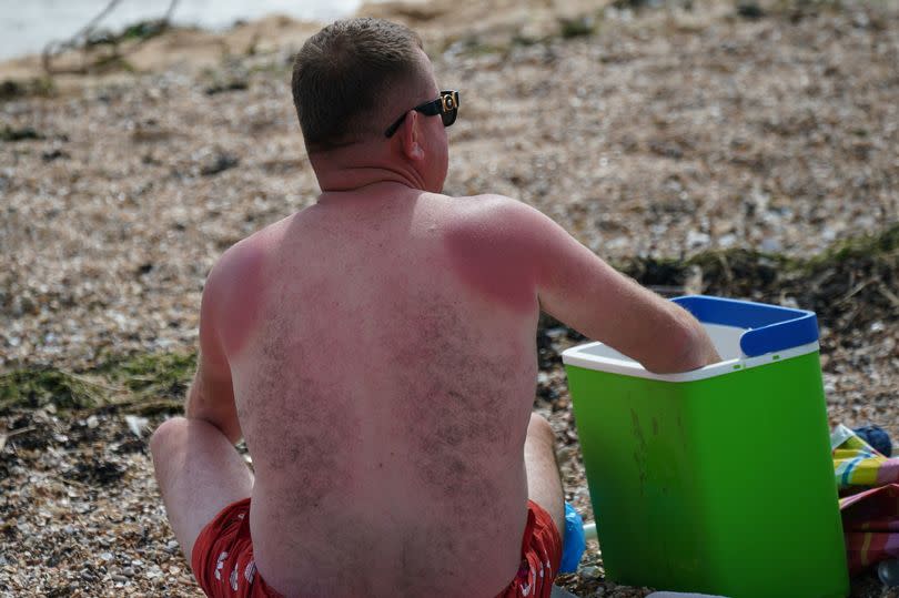 A man with sun burnt shoulders sits on Shoebury Common beach