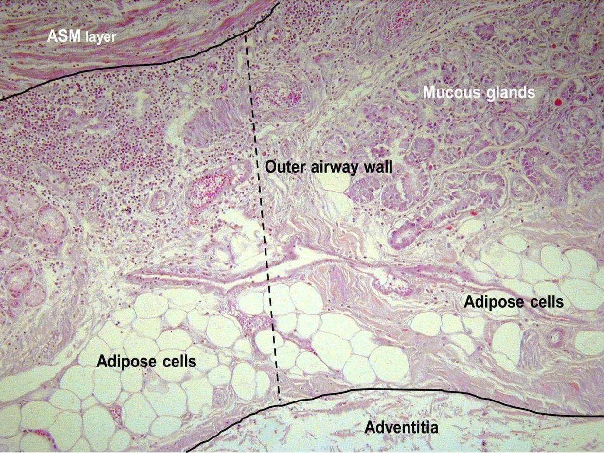 Pictured is accumulation of fat (adipose cells) on the airway inside the lungs of someone who died from an asthma attack: European Respiratory Journal