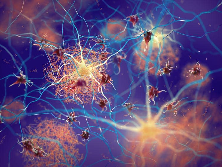 An illustration of plaques forming in the brain.