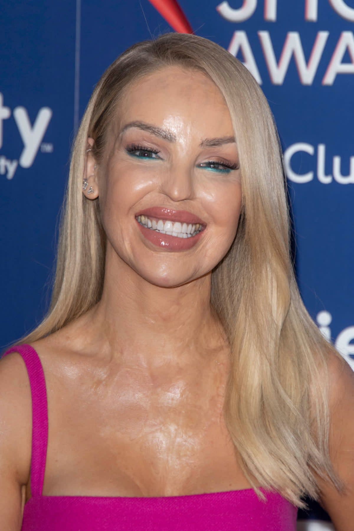 The ‘Corrie’ team worked with Katie Piper’s foundation while researching the storyline – the TV presenter survived an acid attack in 2008 (Getty)