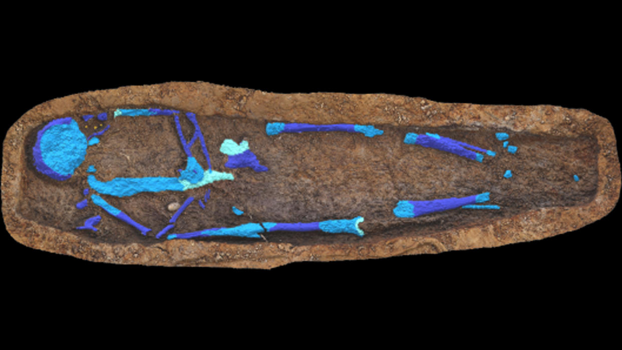  Overview of the skeleton (shaded in blue) during excavation. The preserved porcelain gallbladder can be seen in the right side of the woman’s torso. . 