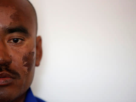 Indian climber Nava Kumar Phukon, who says he successfully climbed Mount Everest, speaks with the media with a bruise on his face, at a hotel in Kathmandu Nepal, May 24, 2016. REUTERS/Navesh Chitrakar