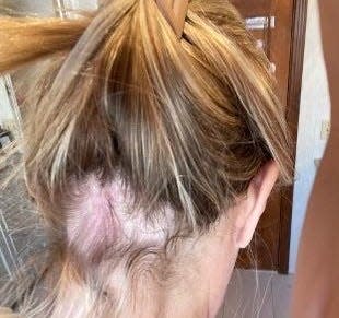 This woman believes her thinning hair and skin condition were caused by using Olaplex. She's among 28 people suing the company, which denies wrongdoing.