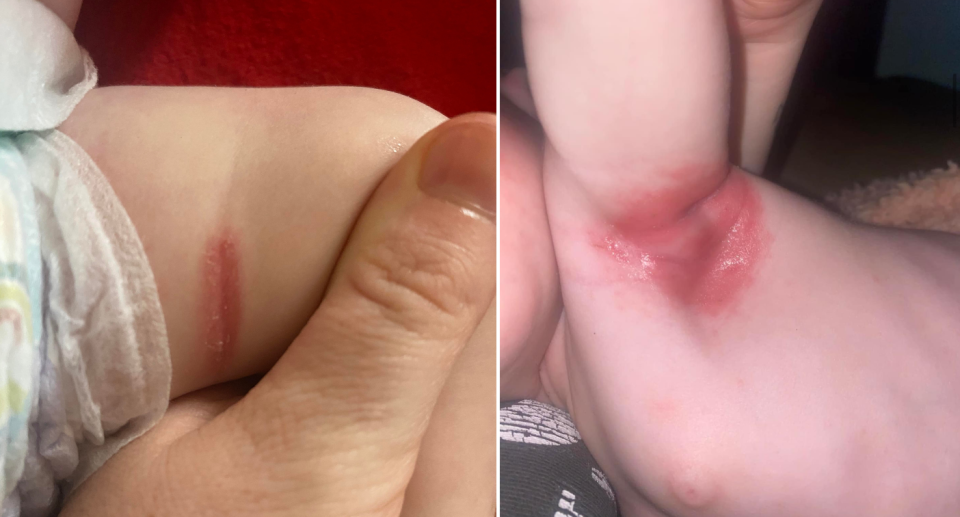 Baby's leg with a rash in fold of skin (left) and the baby's armpit with large rash (right)