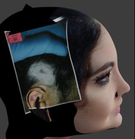 Lawrence Baitland's 3D model of Cayley Mandadi's head with the autopsy photo  of the bruise above her ear  layered in.  / Credit: Lawrence Baitland