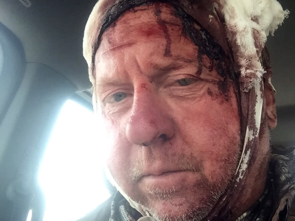 Tom Sommers was bitten and slashed in the head by a grizzly bear: AP