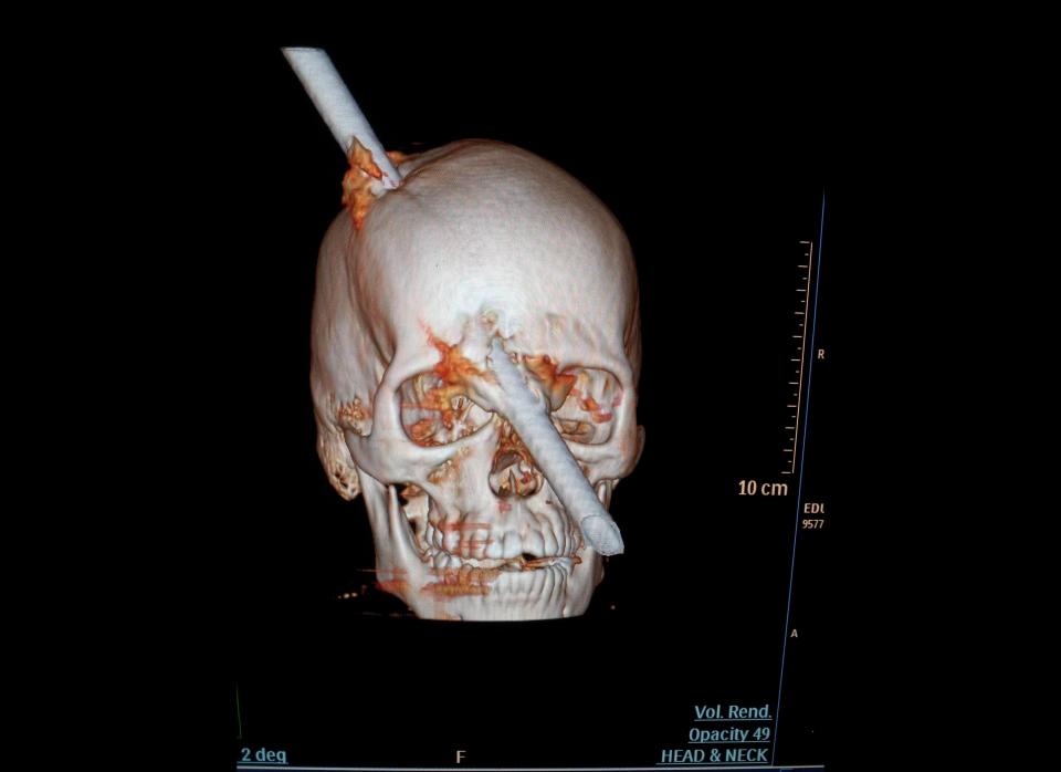 This tomography scan released Thursday, Aug. 16, 2012 by the Miguel Couto hospital, show the skull of 24-year-old construction worker Eduardo Leite pierced by a metal bar in Rio de Janeiro, Brazil. Doctors say Leite survived after a 6-foot metal bar fell from above him and pierced his head. Luiz Essinger of Rio de Janeiro's Miguel Couto Hospital Friday told the Globo TV network that doctor's successfully withdrew the iron bar during a five-hour-long surgery.