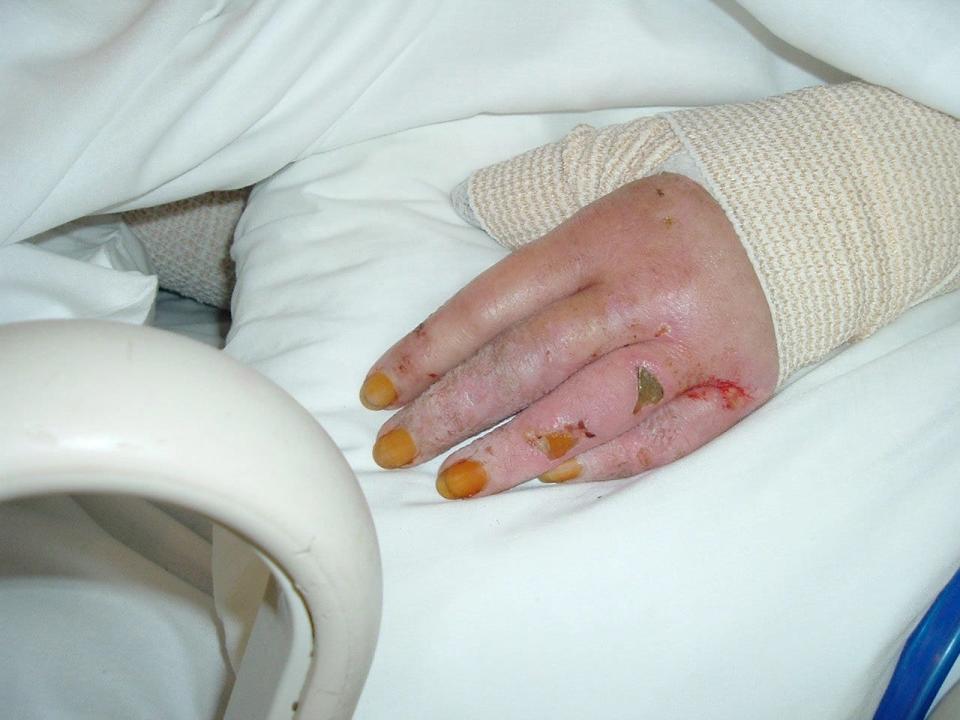 Becky Slabaugh's swollen hand after she was attacked by her husband on July 10, 2004. Photo courtesy of the Becky Slabaugh family.