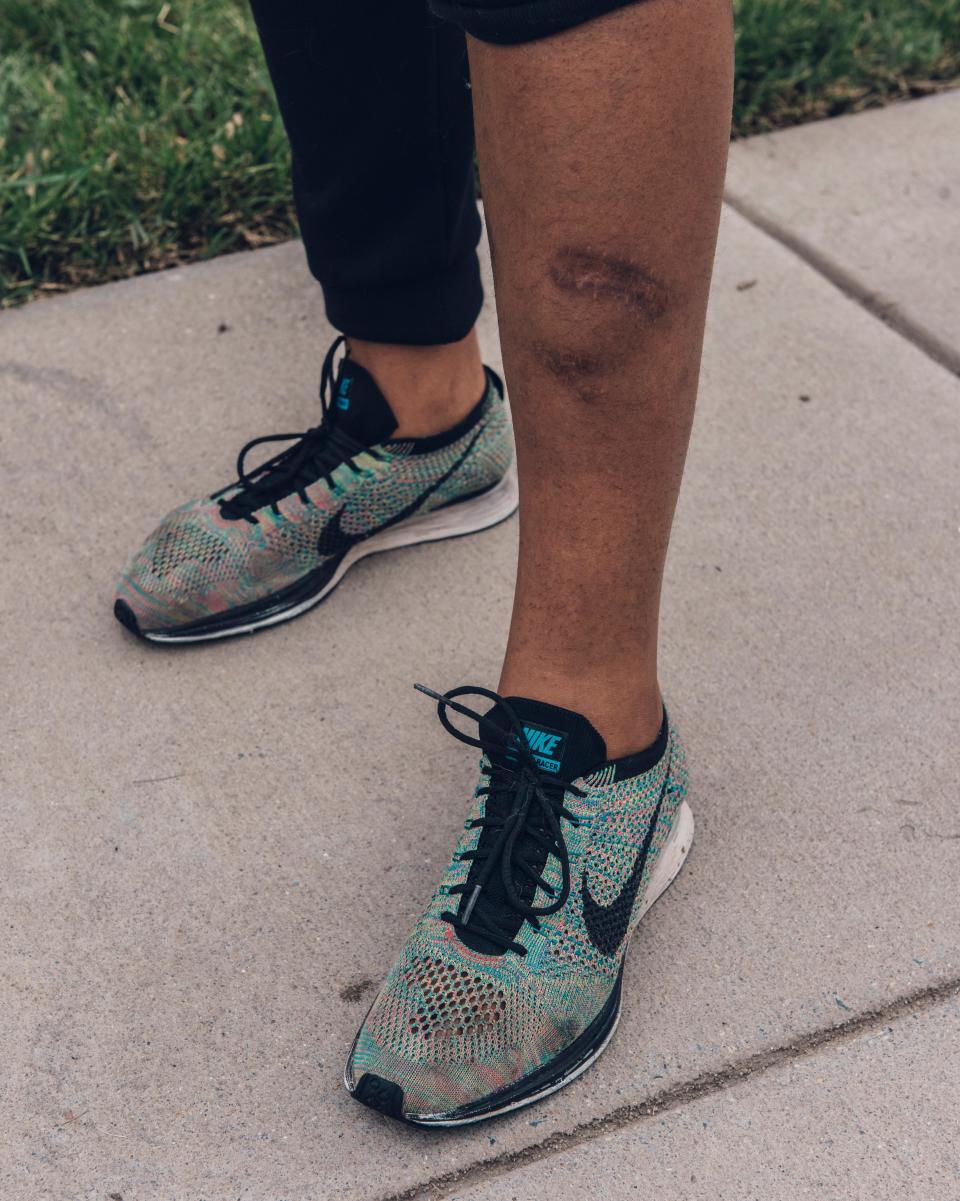 Ayanna Brooks, displays the bite mark scar from a Takoma Park Police K-9, in the Takoma neighborhood of Washington, D.C., Sept. 27, 2020. In December 2018, Brooks and her boyfriend, Joseph Burroughs were walking their dog Neptune when a Takoma Park Police K-9 attacked Brooks, biting her left leg.