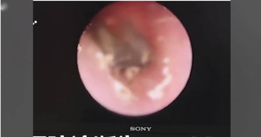 中國大陸一名女子疑似因掏耳過度，反讓黴菌在耳道內長出「蘑菇」。（圖／翻攝自《沸點新聞》微博）