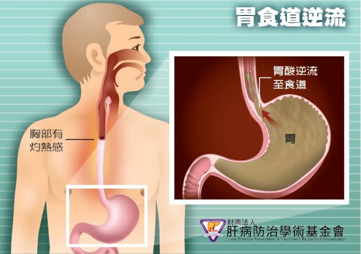 Gastroesophageal reflux